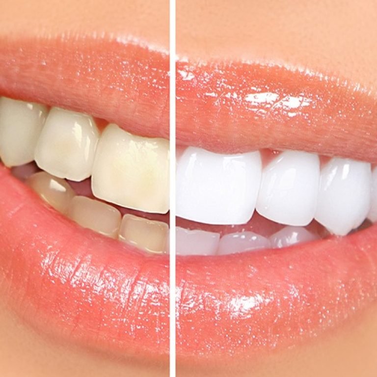 Invisalign treatment for straightening front teeth